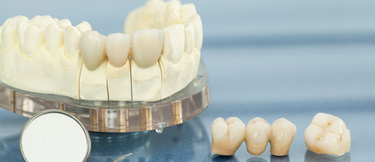Positief effectief Logisch Behandeling kroon of brug - tandarts J-dental Almere Noorderplassen